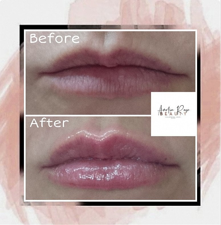 Lip fillers - £70